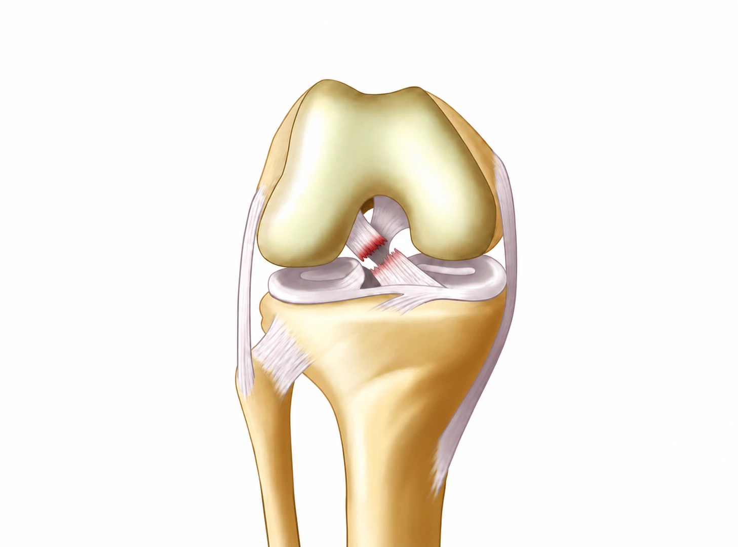 Illustration qualitative d’une sollicitation du genou après rupture complète du ligament croisé antérieur. Le déplacement représenté n’est pas une mesure clinique.
